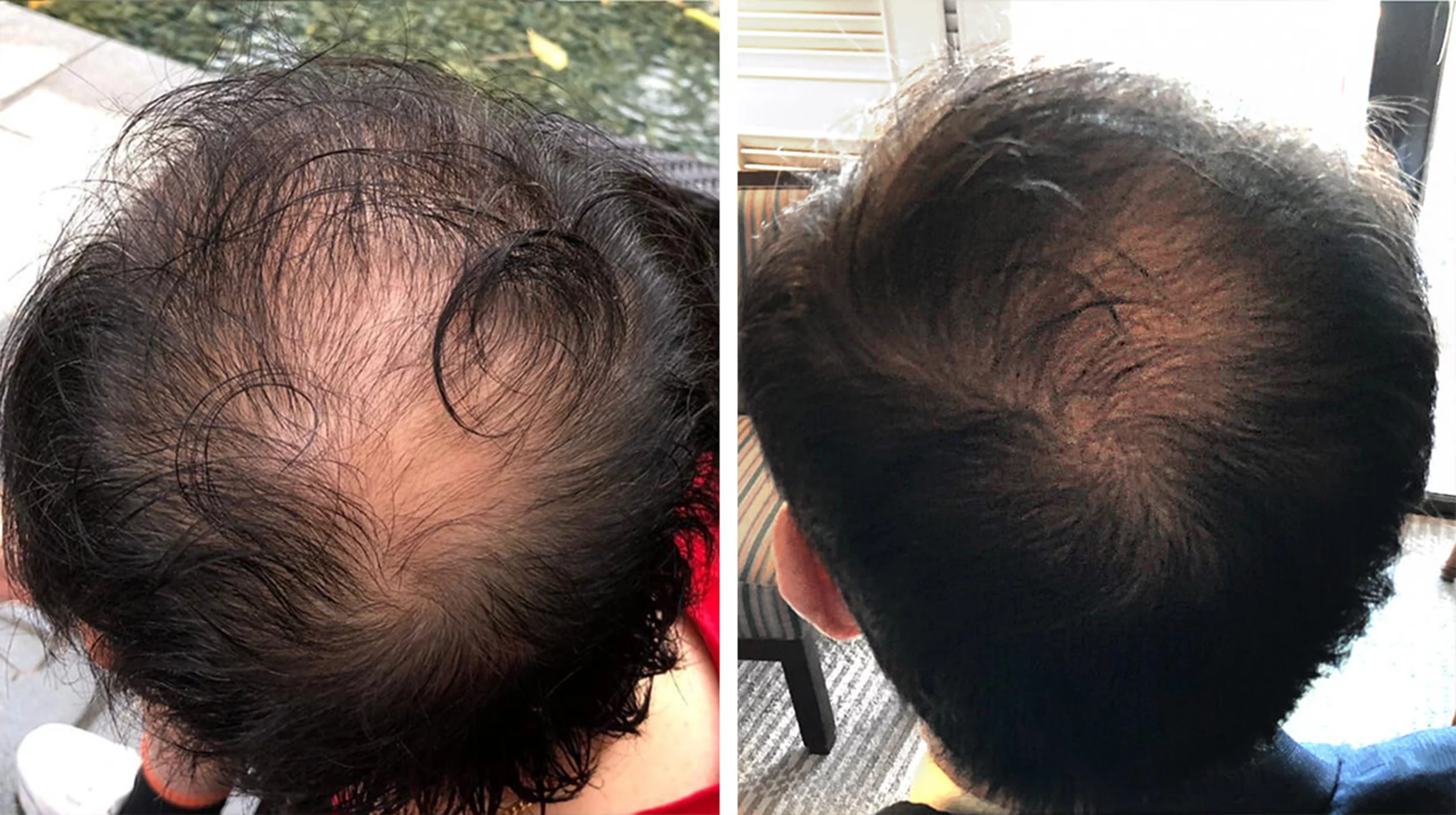 How to Protect Your Hair from Hair Loss at a Young Age